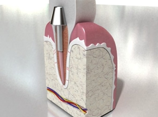 Dental Implant 3D Model .max .obj .3ds .fbx