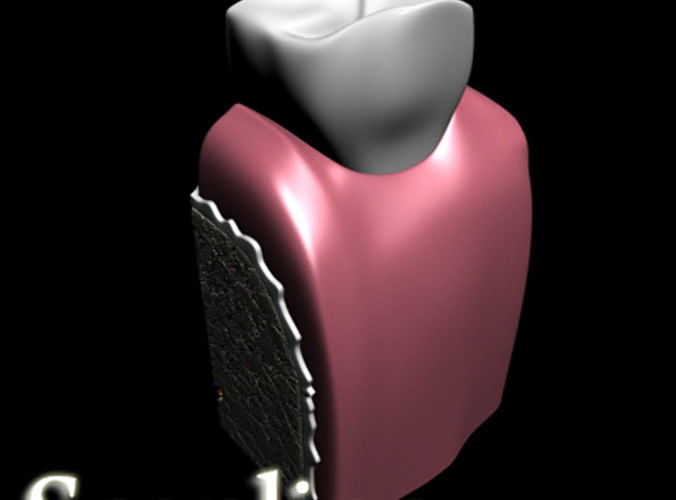 Dental Implant 3D Model .max .obj .3ds .fbx