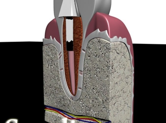 Dental Implant 3D Model .max .obj .3ds .fbx