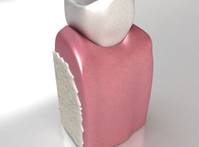 Dental Implant 3D Model .max .obj .3ds .fbx
