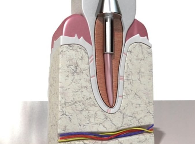 Dental Implant 3D Model .max .obj .3ds .fbx