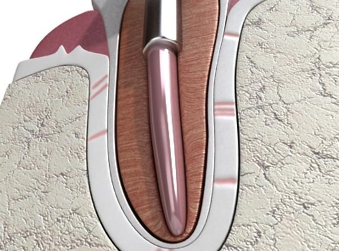 Dental Implant 3D Model .max .obj .3ds .fbx