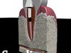 Dental Implant 3D Model .max .obj .3ds .fbx