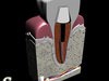 Dental Implant 3D Model .max .obj .3ds .fbx