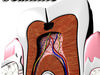 Cracked Tooth High Detail 3D Model .max .obj .3ds .fbx