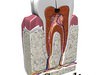 Cracked Tooth High Detail 3D Model .max .obj .3ds .fbx