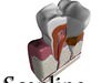 Tooth Dental Plaque High Detail 3D Model .max .obj .3ds .fbx
