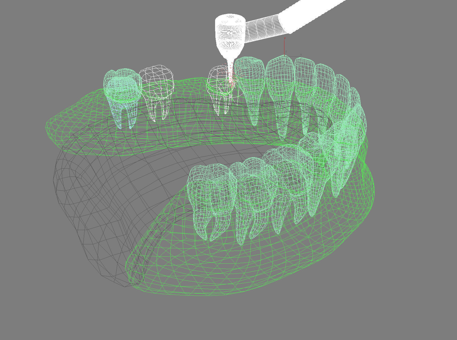 Tooth supported fixed bridge and single crown 3D model_11