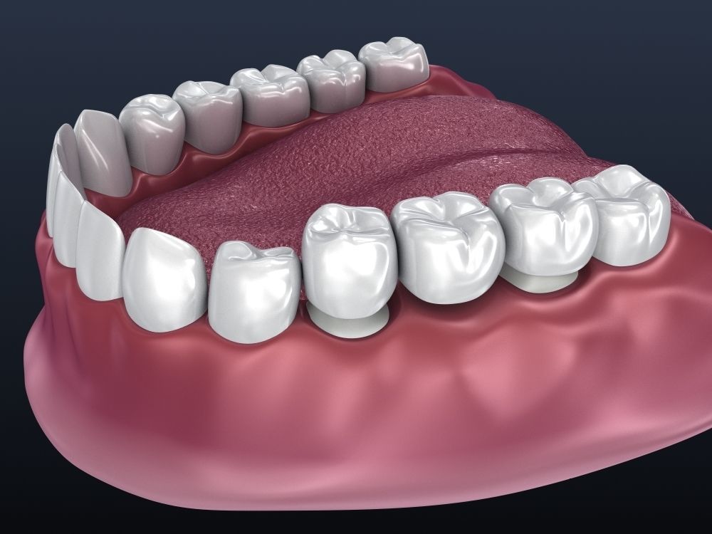 Tooth supported fixed bridge and single crown 3D model_5