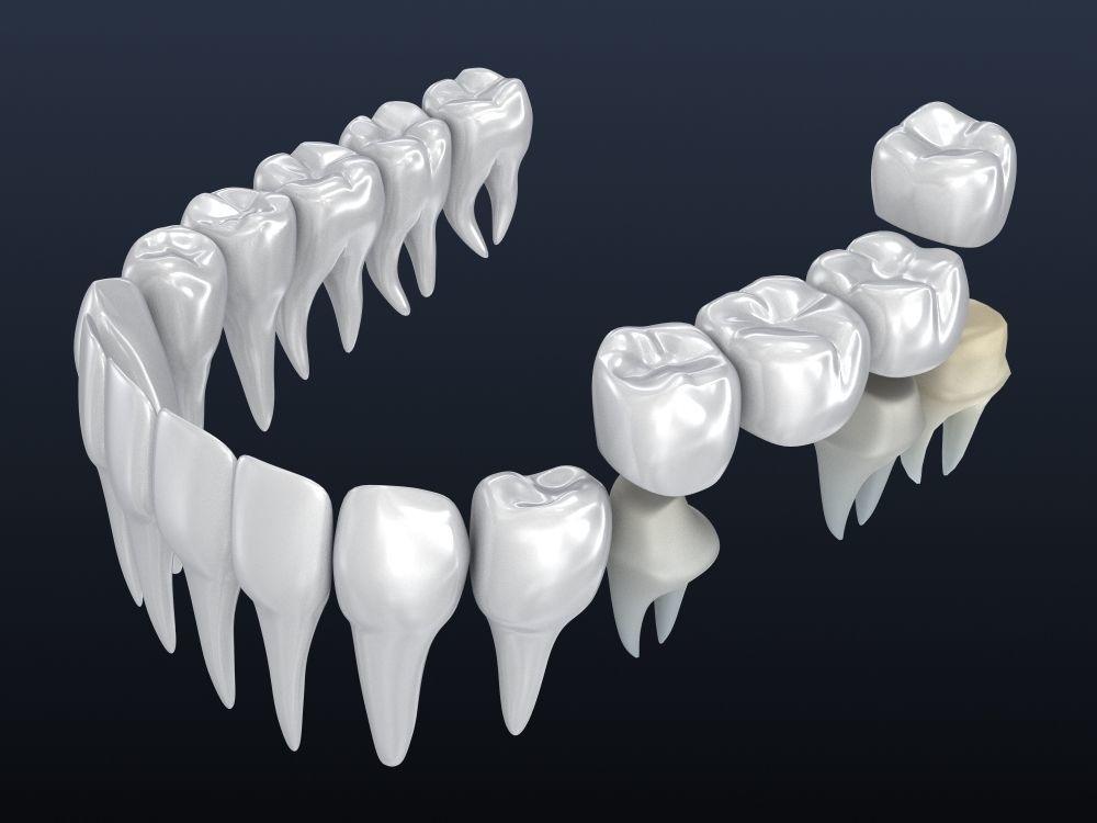 Tooth supported fixed bridge and single crown 3D model_9