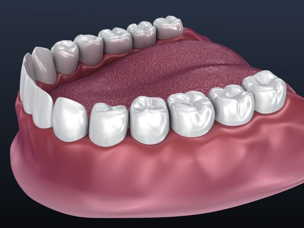 Tooth supported fixed bridge and single crown 3D model_6