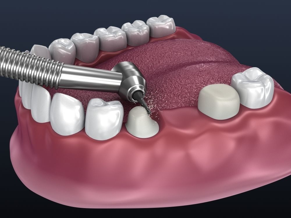 Tooth supported fixed bridge and single crown 3D model_2