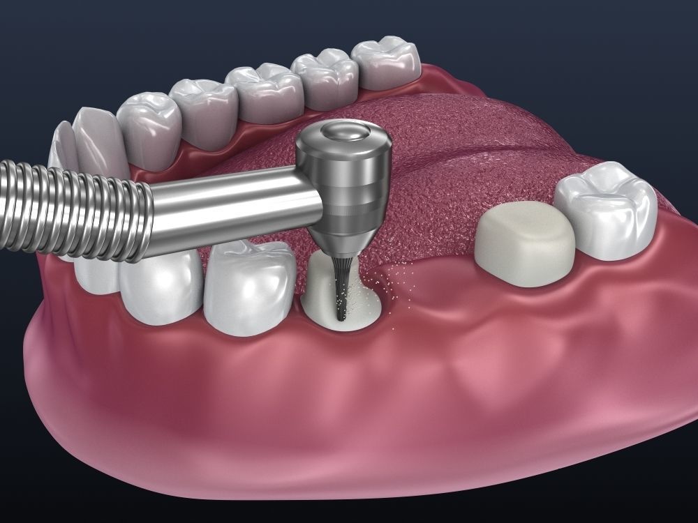 Tooth supported fixed bridge and single crown 3D model_1
