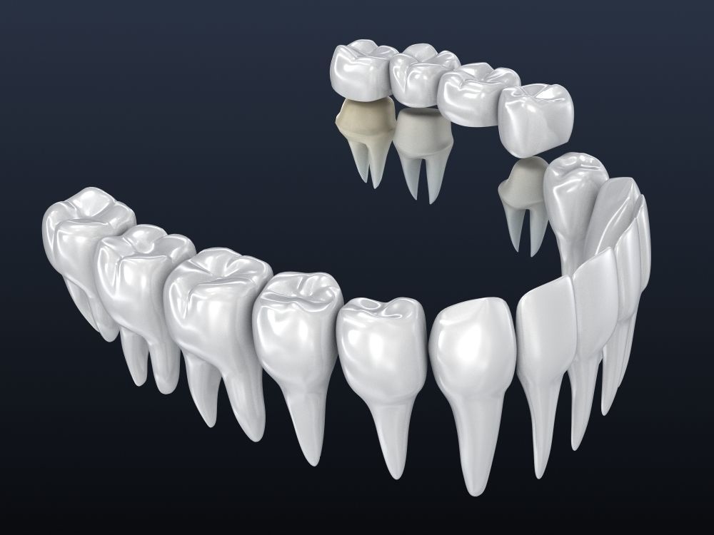 Tooth supported fixed bridge and single crown 3D model_10