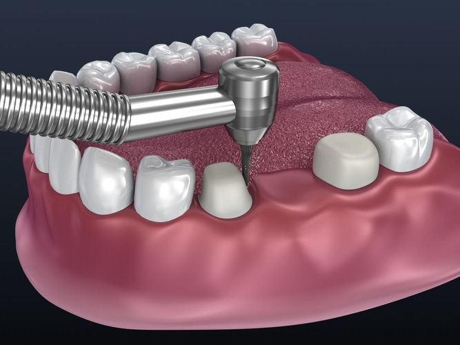 Tooth supported fixed bridge and single crown 3D model