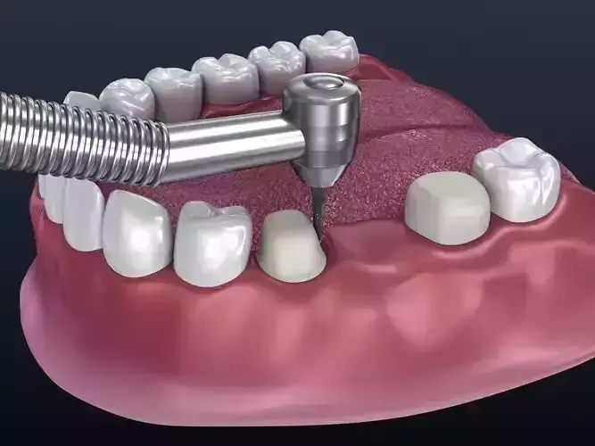 Tooth supported fixed bridge and single crown 3D model