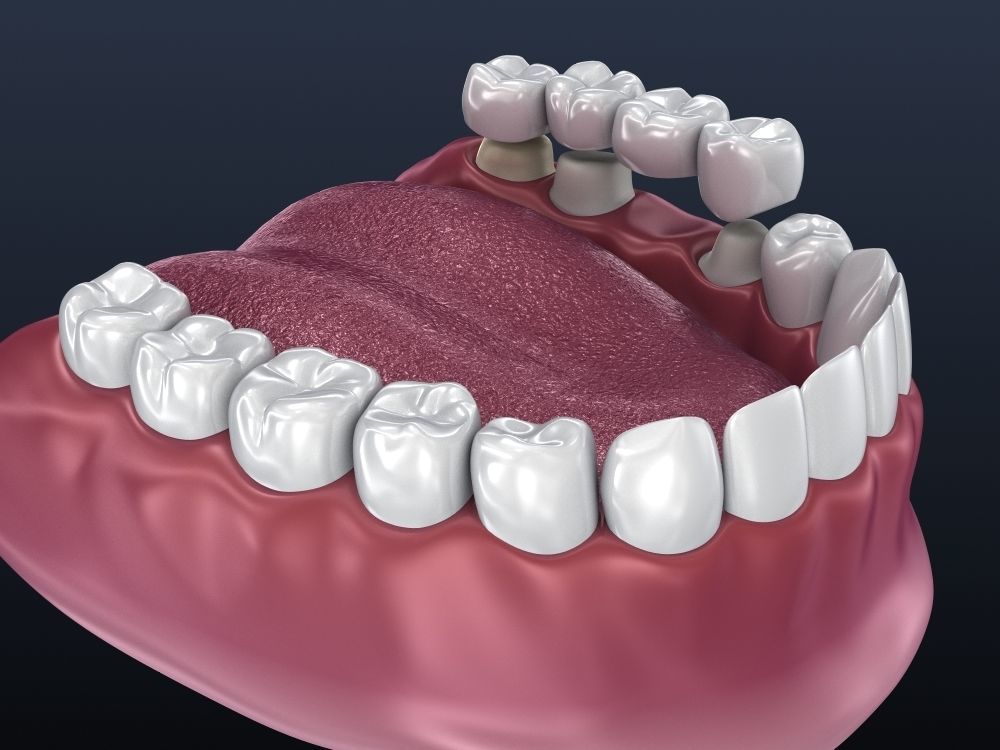Tooth supported fixed bridge and single crown 3D model_8