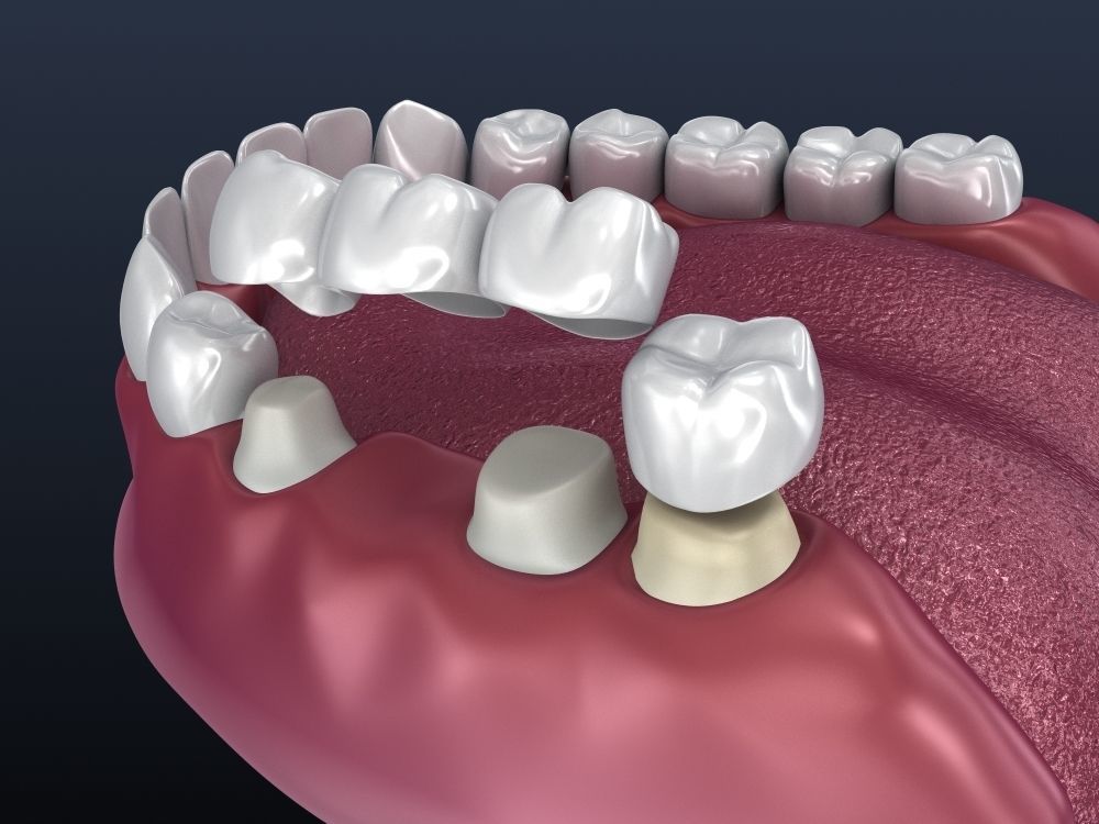 Tooth supported fixed bridge and single crown 3D model_7