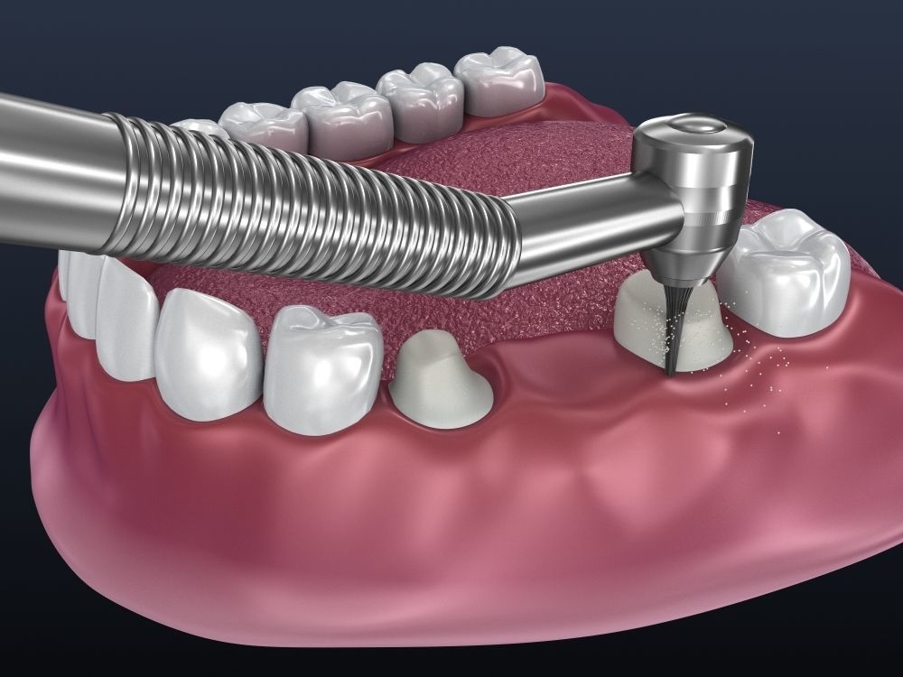 Tooth supported fixed bridge and single crown 3D model_3