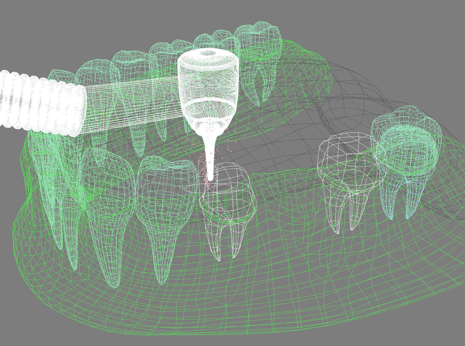 Tooth supported fixed bridge and single crown 3D model_12