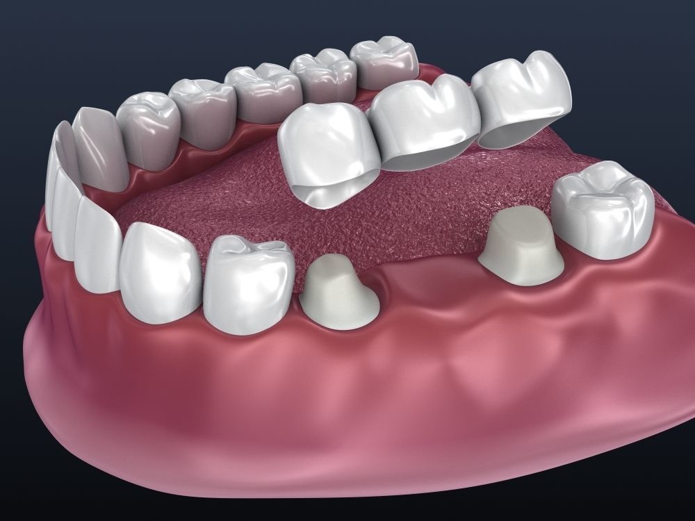 Tooth supported fixed bridge and single crown 3D model_4