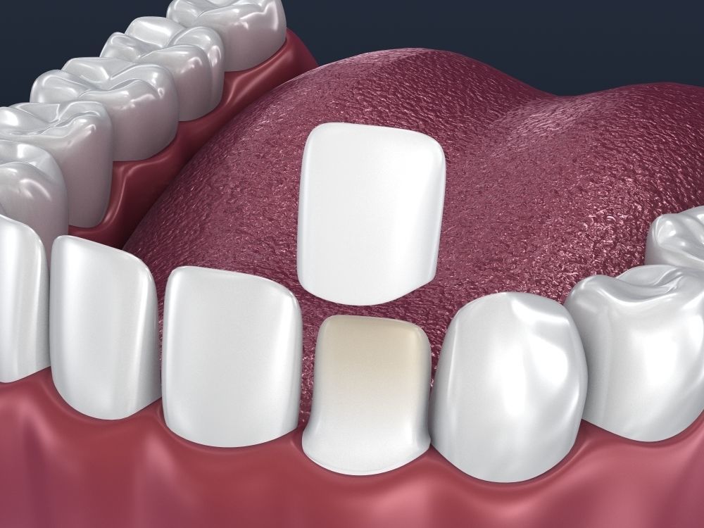Dental veneer preparation and instalation 3D model_2