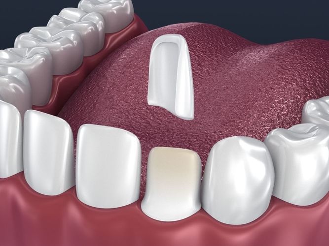 Dental veneer preparation and instalation 3D model