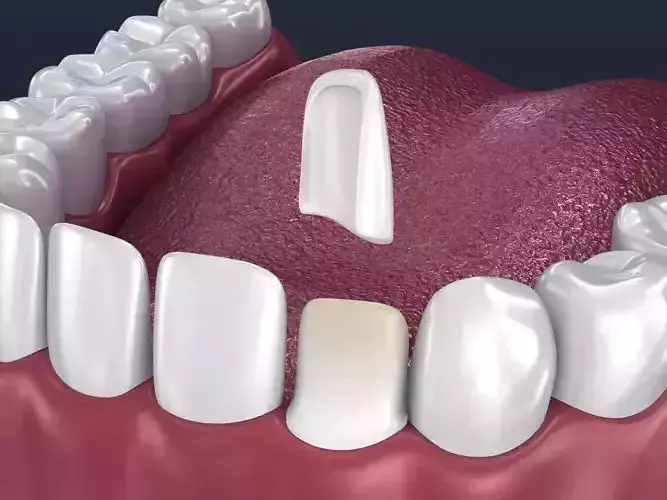 Dental veneer preparation and instalation 3D model