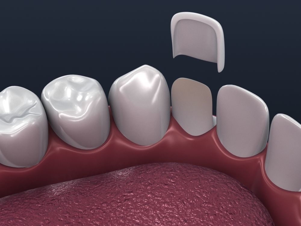 Dental veneer preparation and instalation 3D model_4