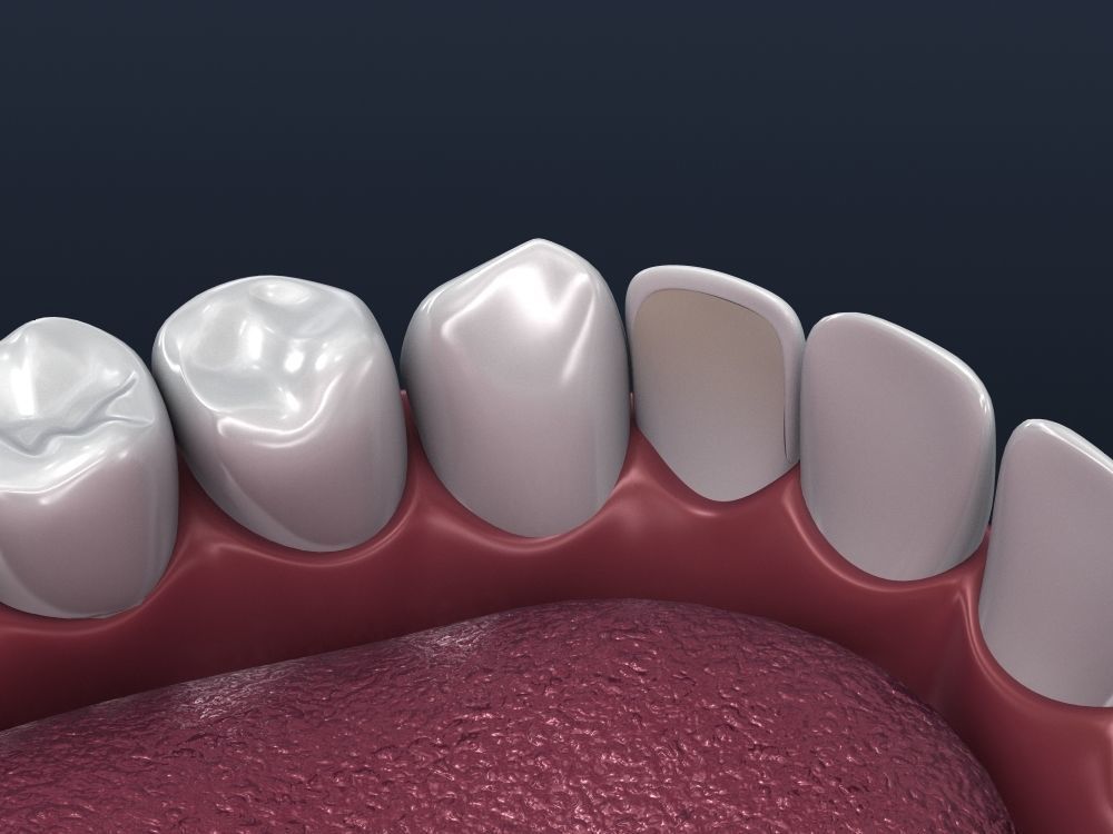 Dental veneer preparation and instalation 3D model_6