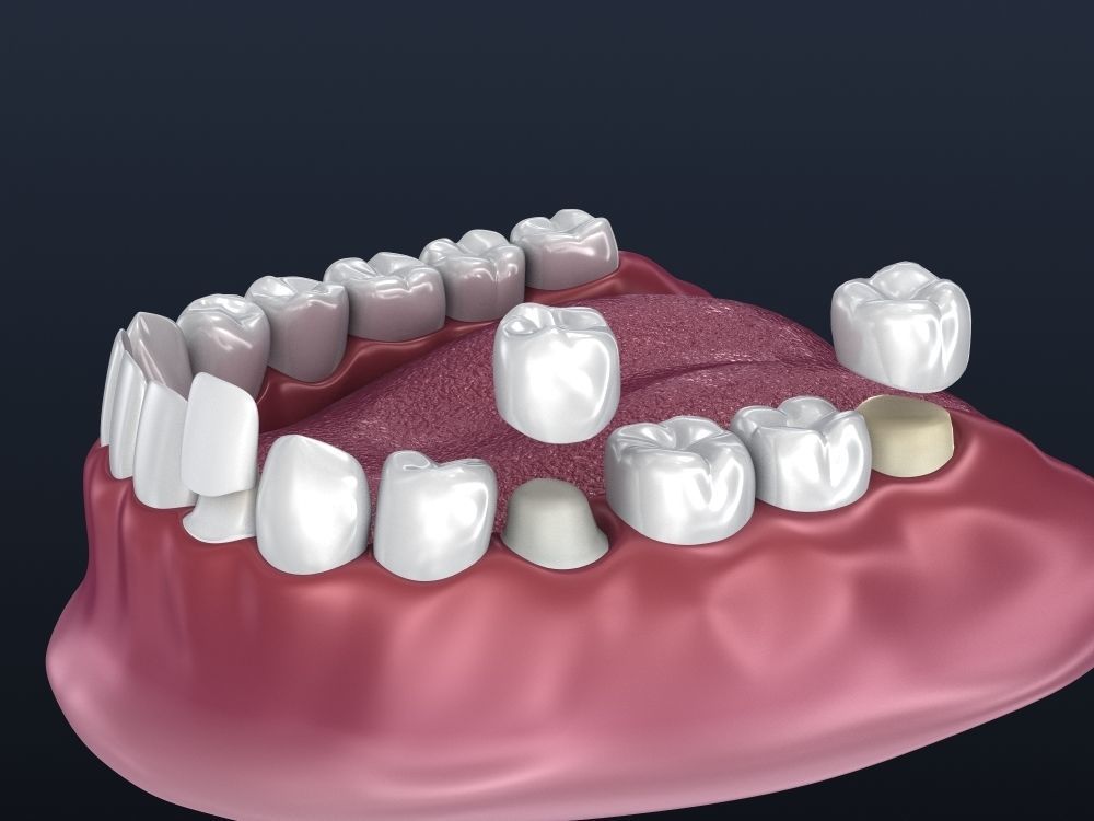 Dental veneer preparation and instalation 3D model_8