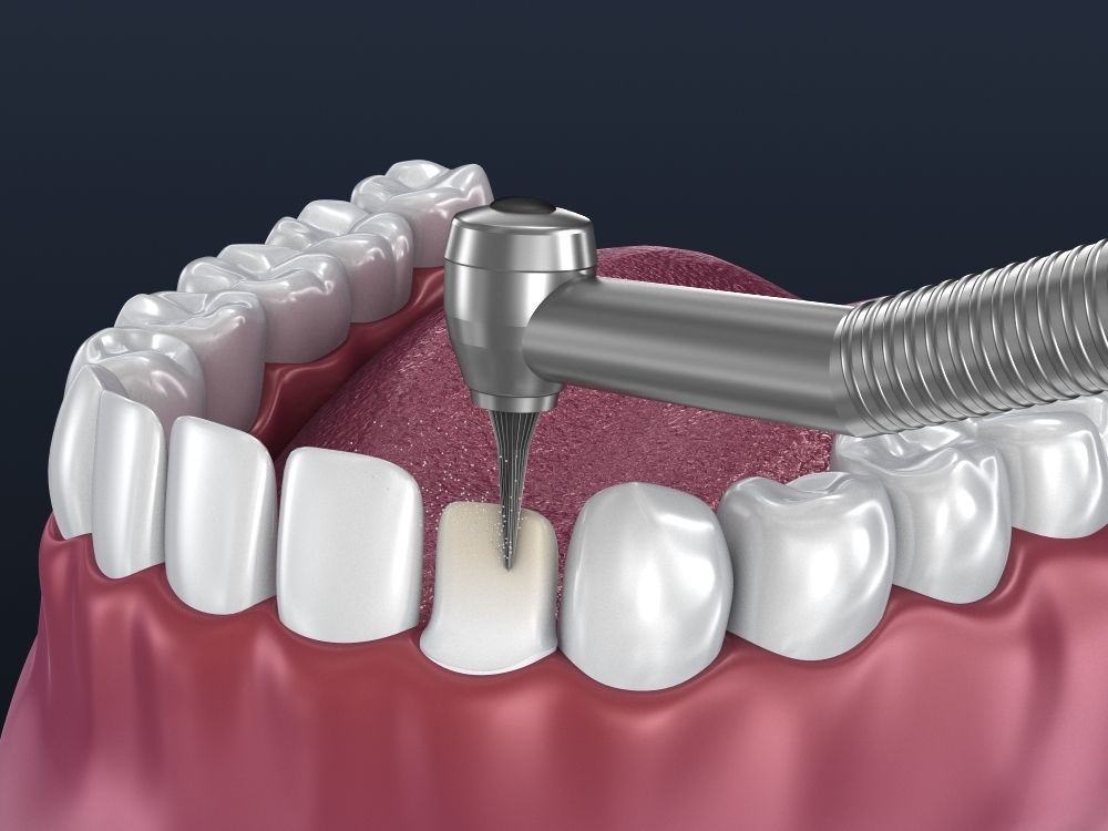 Dental veneer preparation and instalation 3D model_5