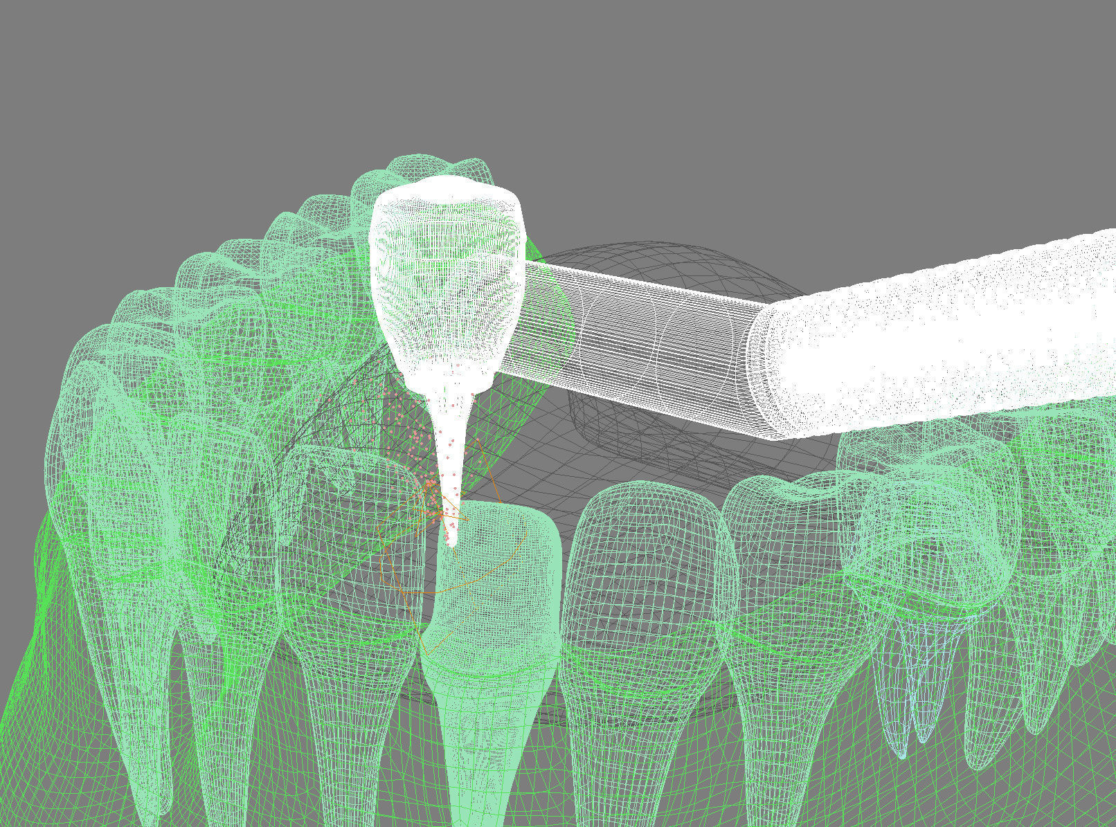 Dental veneer preparation and instalation 3D model_11