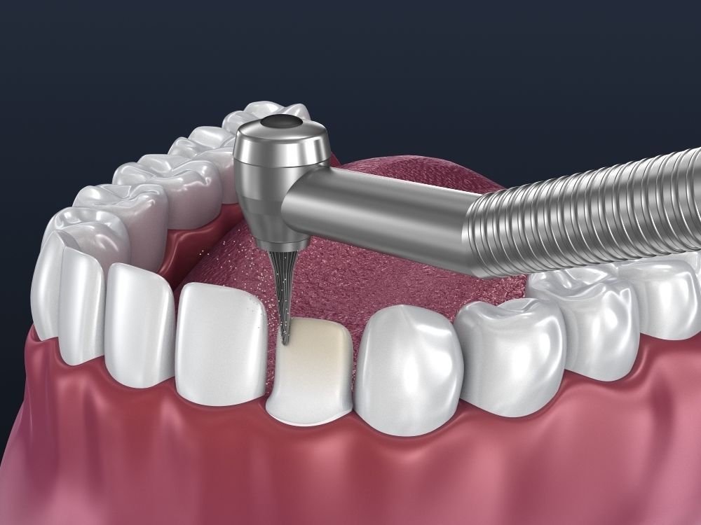 Dental veneer preparation and instalation 3D model_1