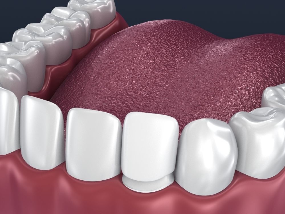 Dental veneer preparation and instalation 3D model_3