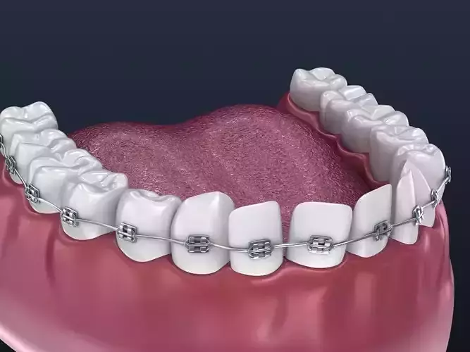 Dental orthodontic braces 3D model