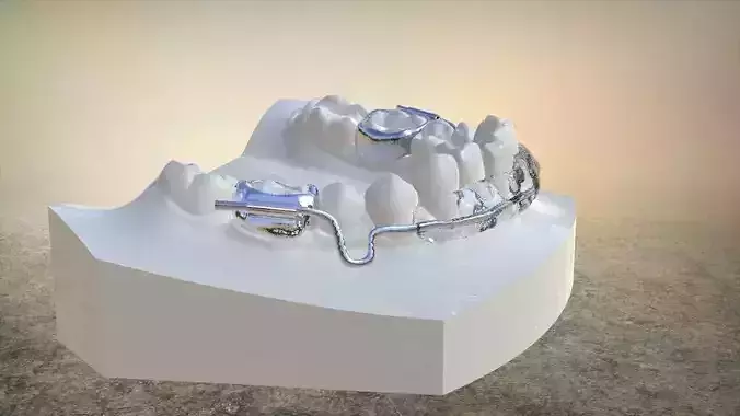 Digital Lip Bumper Appliance 3D print model