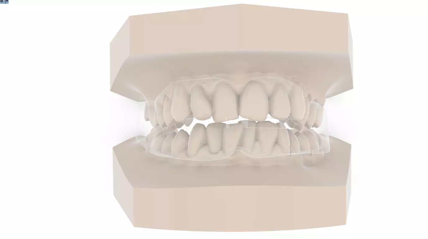 Digital Anti-snoring Mouthguard 3D print model_0