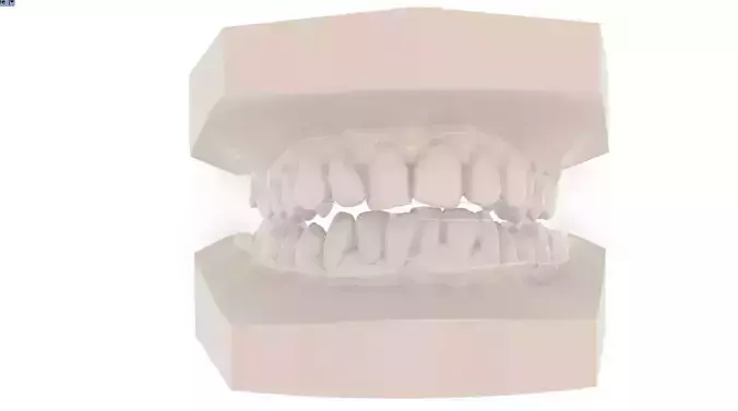 Digital Anti-snoring Mouthguard 3D print model