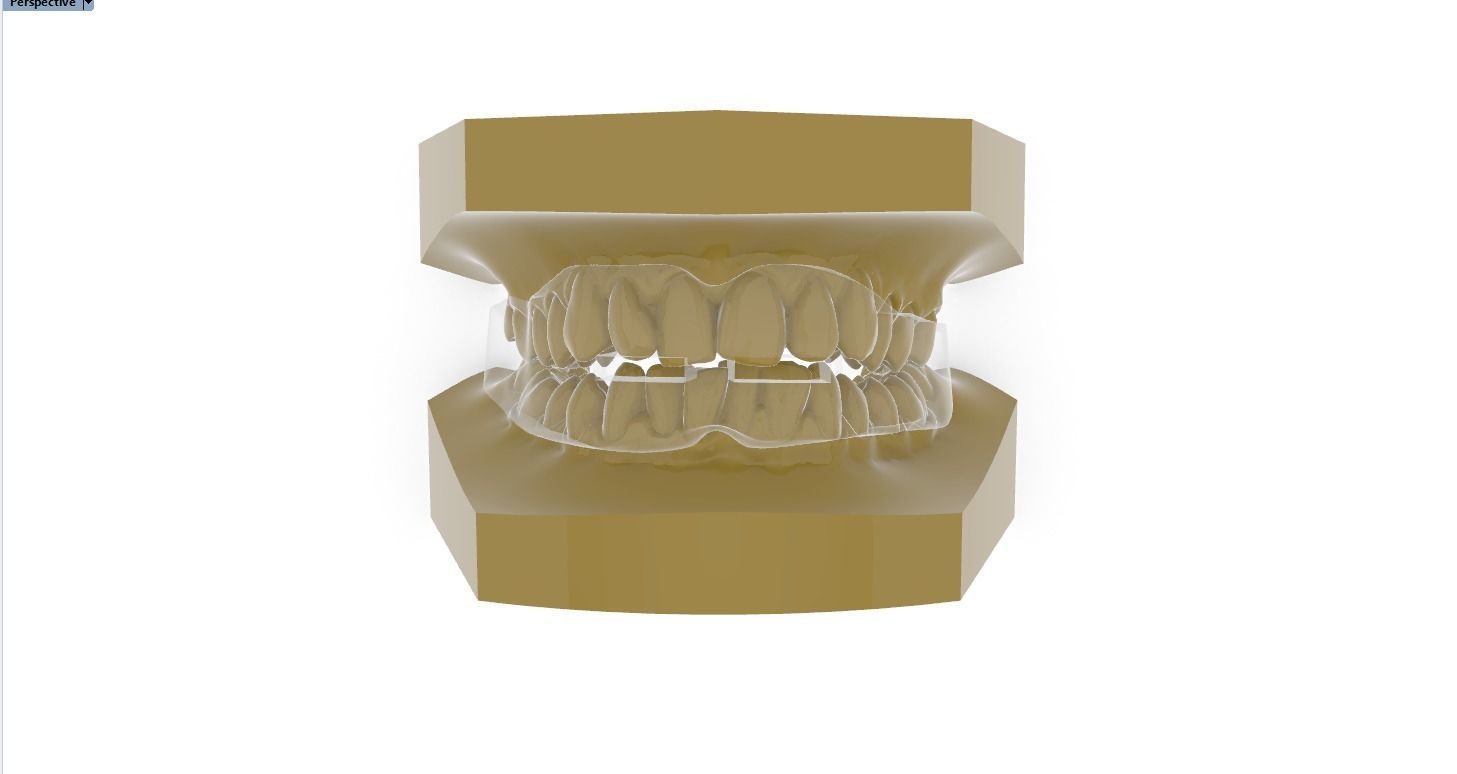 Digital Anti-snoring Mouthguard 3D print model_2