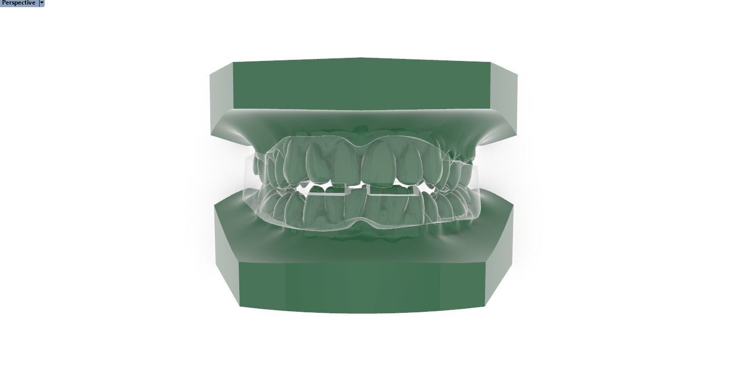 Digital Anti-snoring Mouthguard 3D print model_3