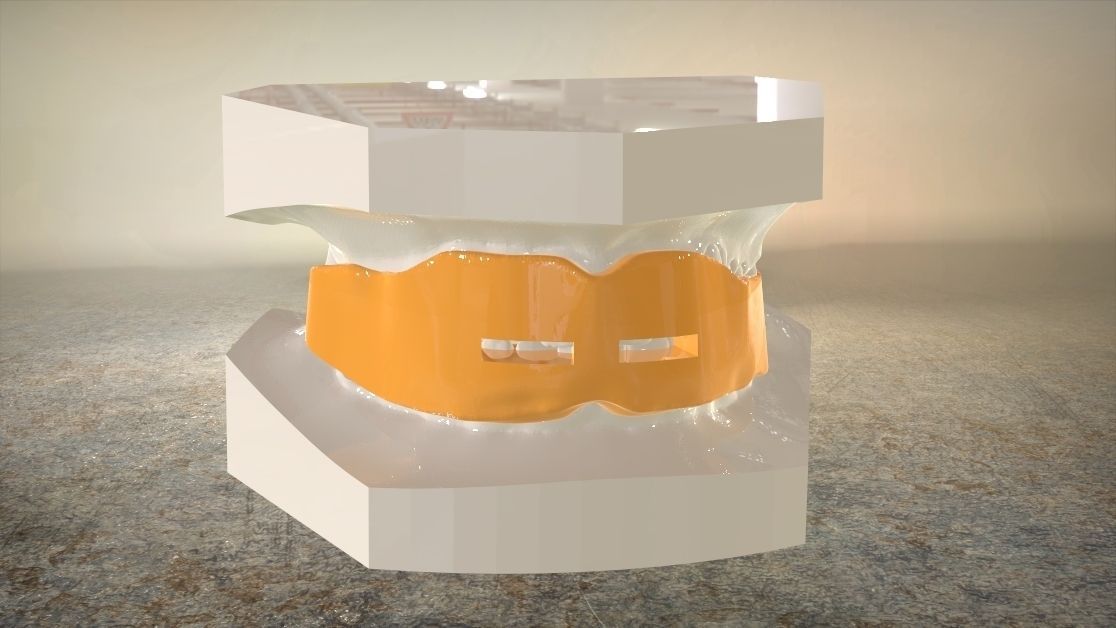 Digital Anti-snoring Mouthguard 3D print model_14