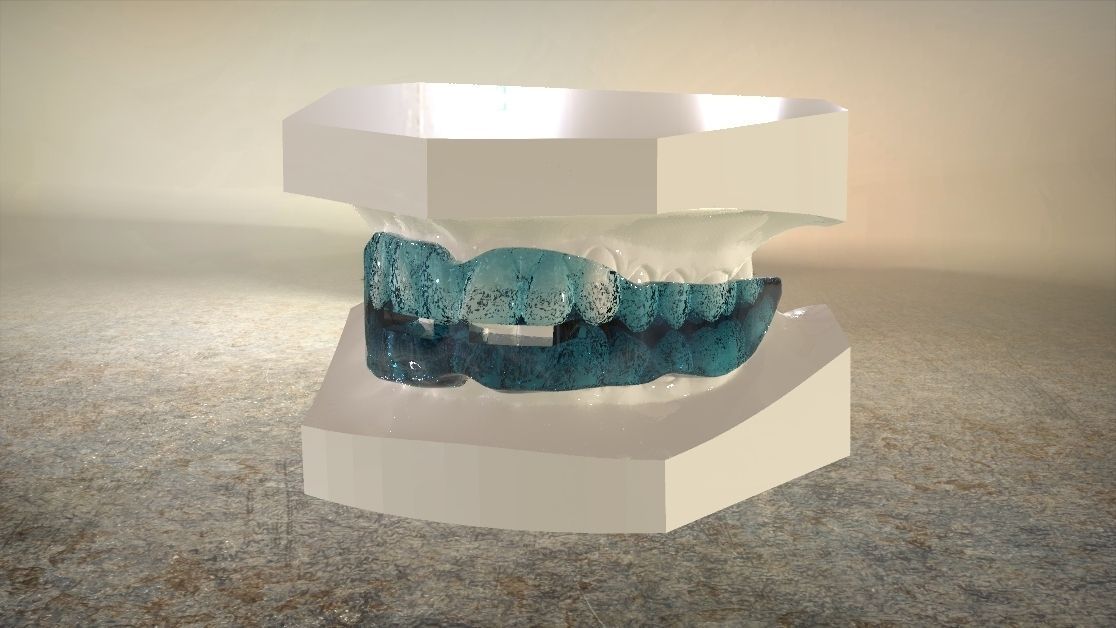 Digital Anti-snoring Mouthguard 3D print model_9