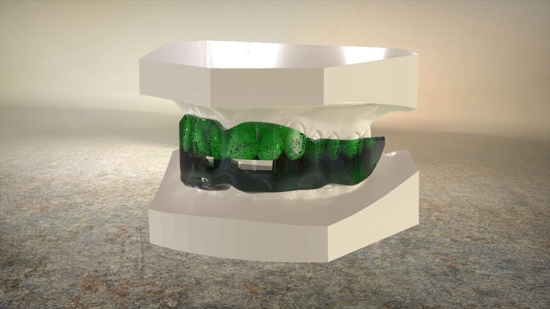 Digital Anti-snoring Mouthguard 3D print model_11