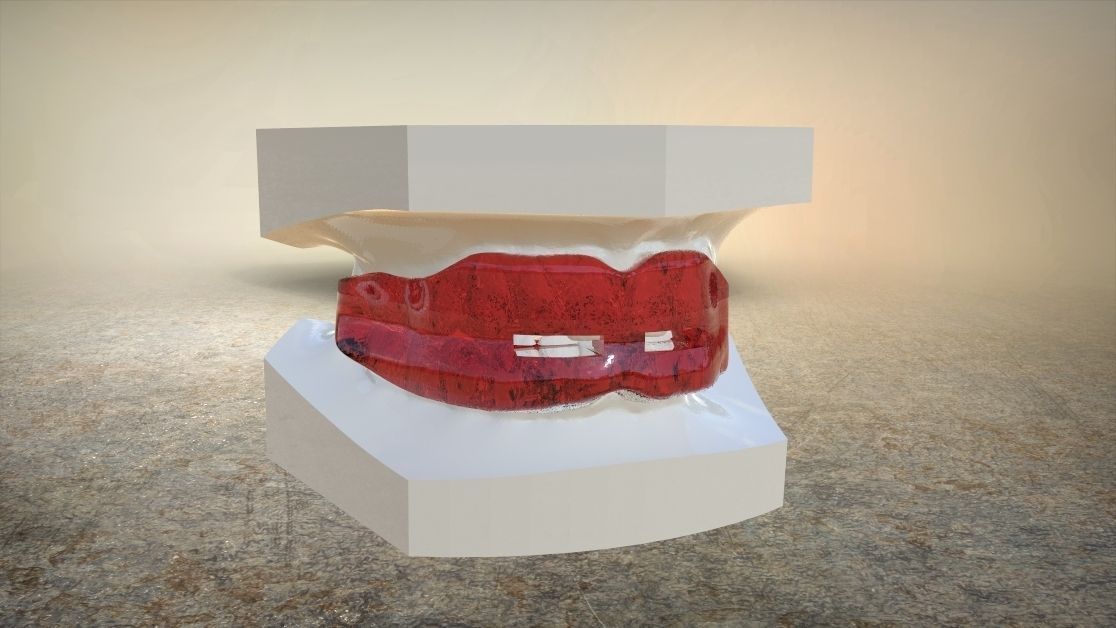 Digital Anti-snoring Mouthguard 3D print model_12
