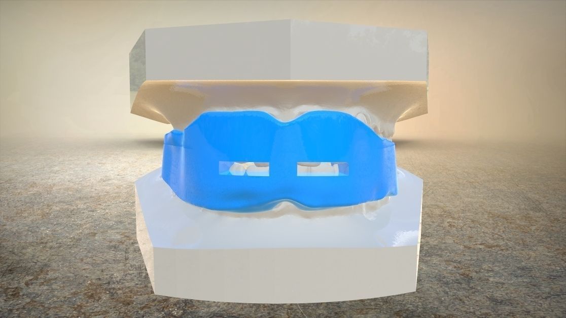 Digital Anti-snoring Mouthguard 3D print model_8