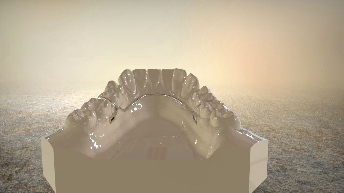 Digital Tanner Splint Orthodontics 3D print model_4