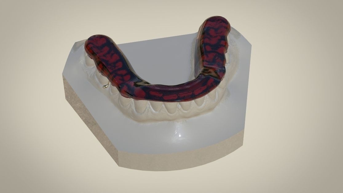 Digital Tanner Splint Orthodontics 3D print model_9