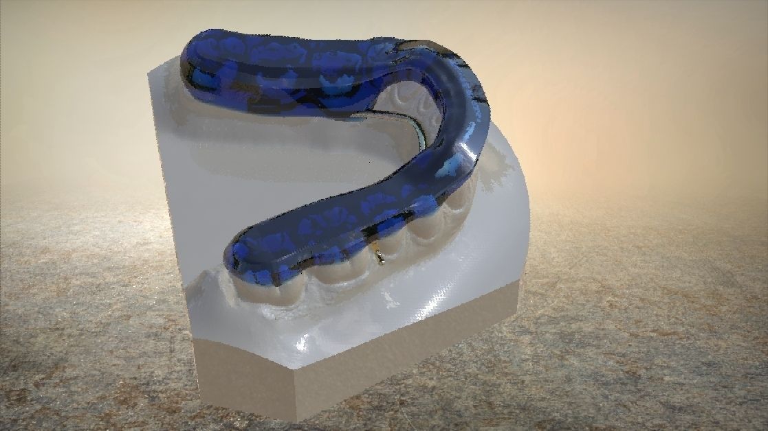 Digital Tanner Splint Orthodontics 3D print model_7