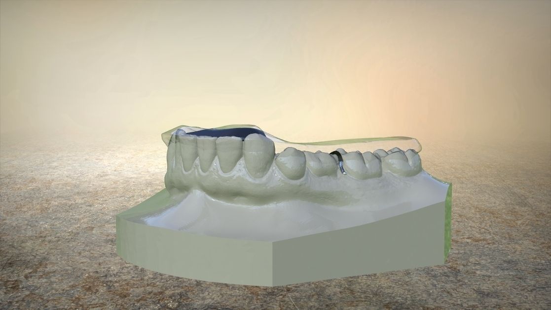 Digital Tanner Splint Orthodontics 3D print model_3